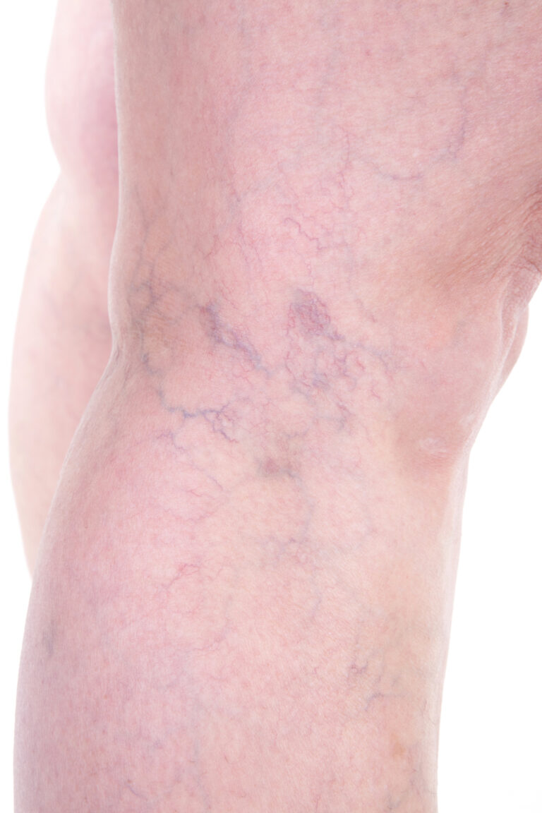 Varicose Vein on leg.